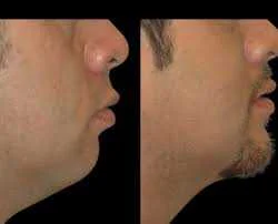 What Are the Real Benefits of Double Chin Removal in Dubai